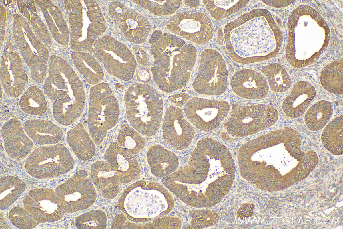 IHC staining of human colon cancer using 15708-1-AP