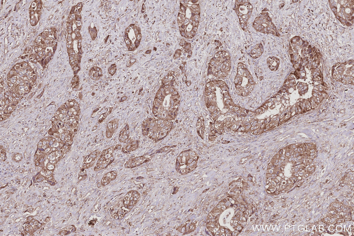 IHC staining of human pancreas cancer using 15708-1-AP IHC staining of human pancreas cancer using 15708-1-AP