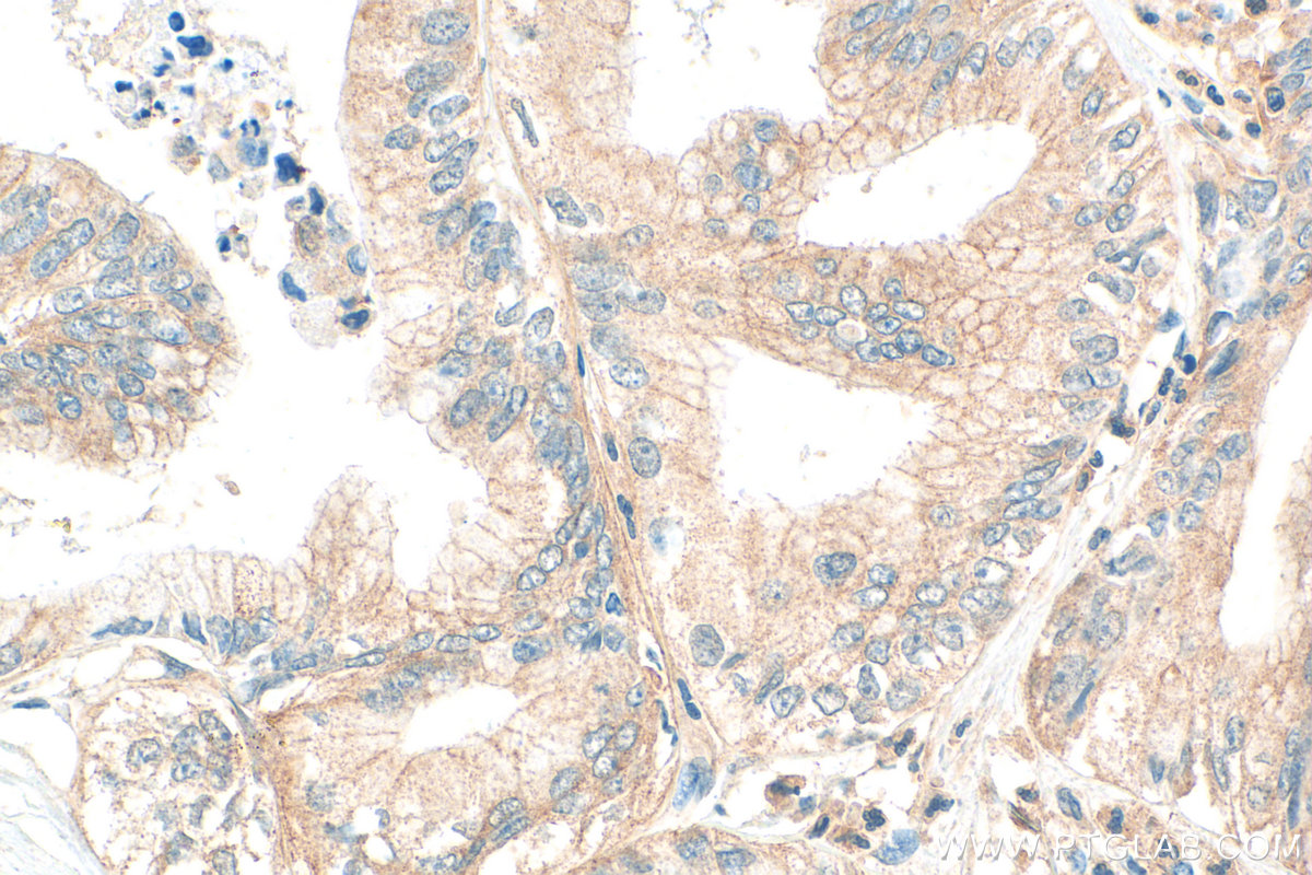 IHC staining of human pancreas cancer using 13847-1-AP