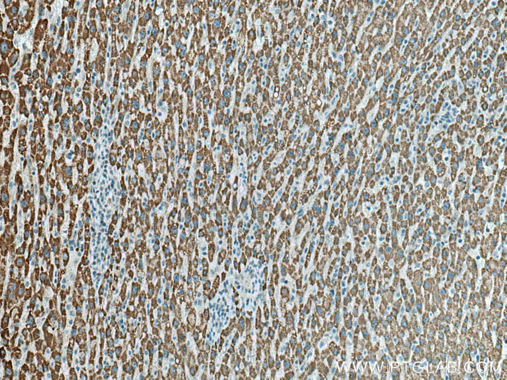 IHC staining of human liver cancer using 22862-1-AP