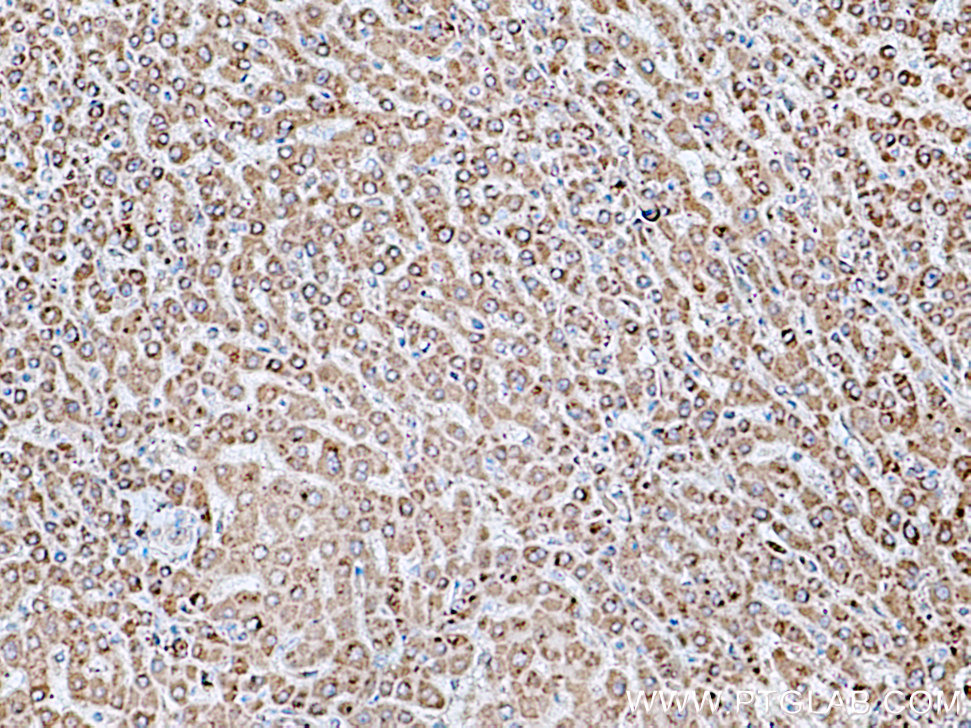 IHC staining of human liver cancer using 16591-1-AP