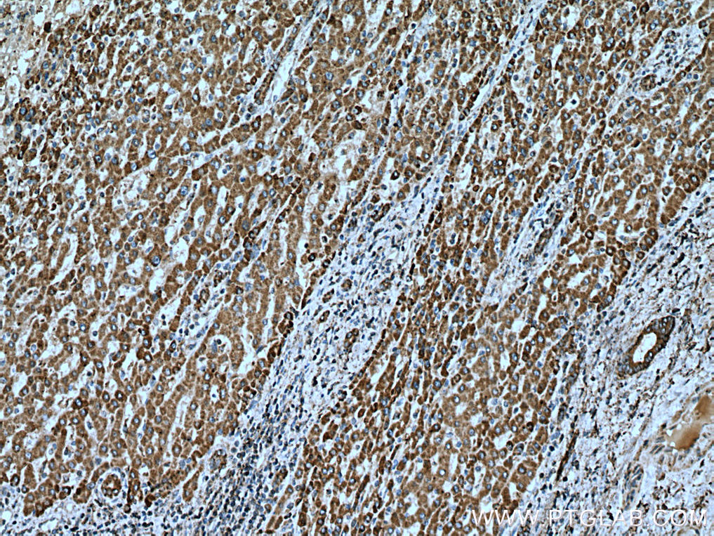 IHC staining of human liver cancer using 67334-1-Ig