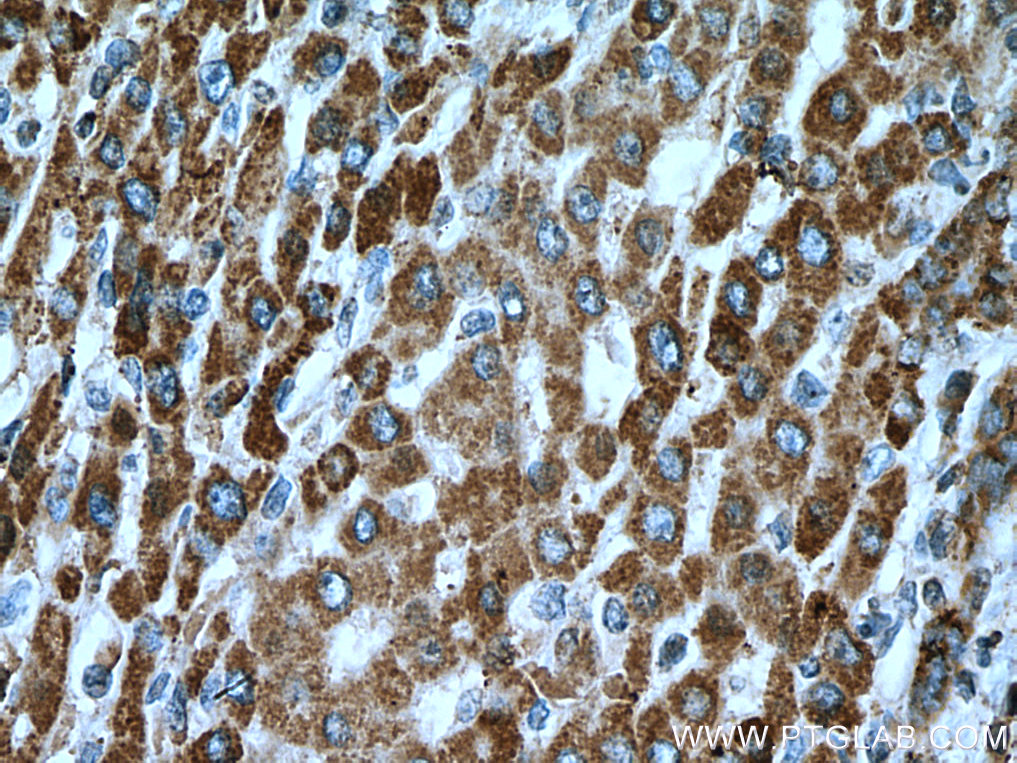 IHC staining of human liver cancer using 67334-1-Ig