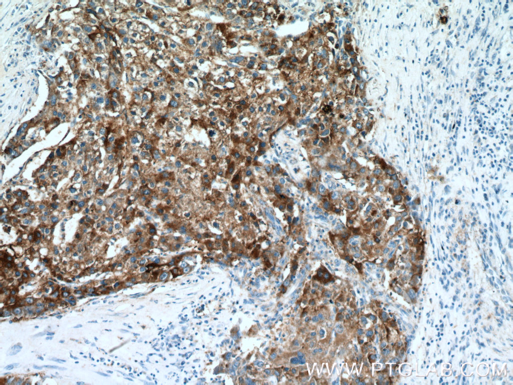IHC staining of human liver cancer using 17138-1-AP