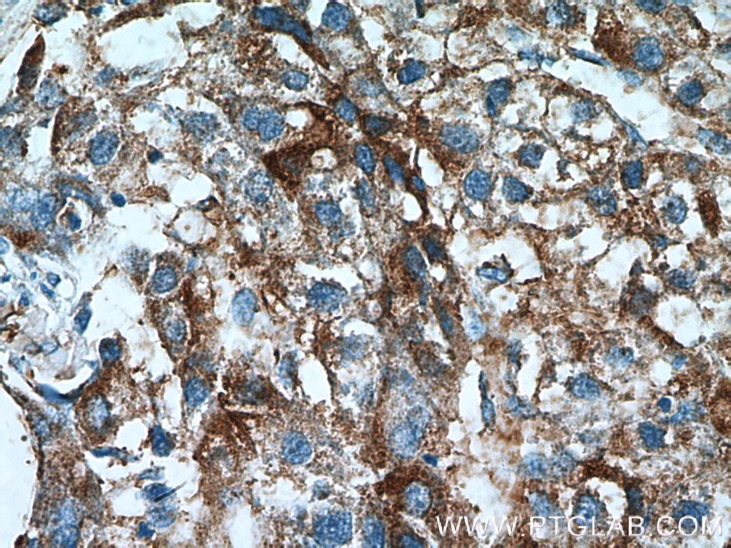 IHC staining of human liver cancer using 17138-1-AP