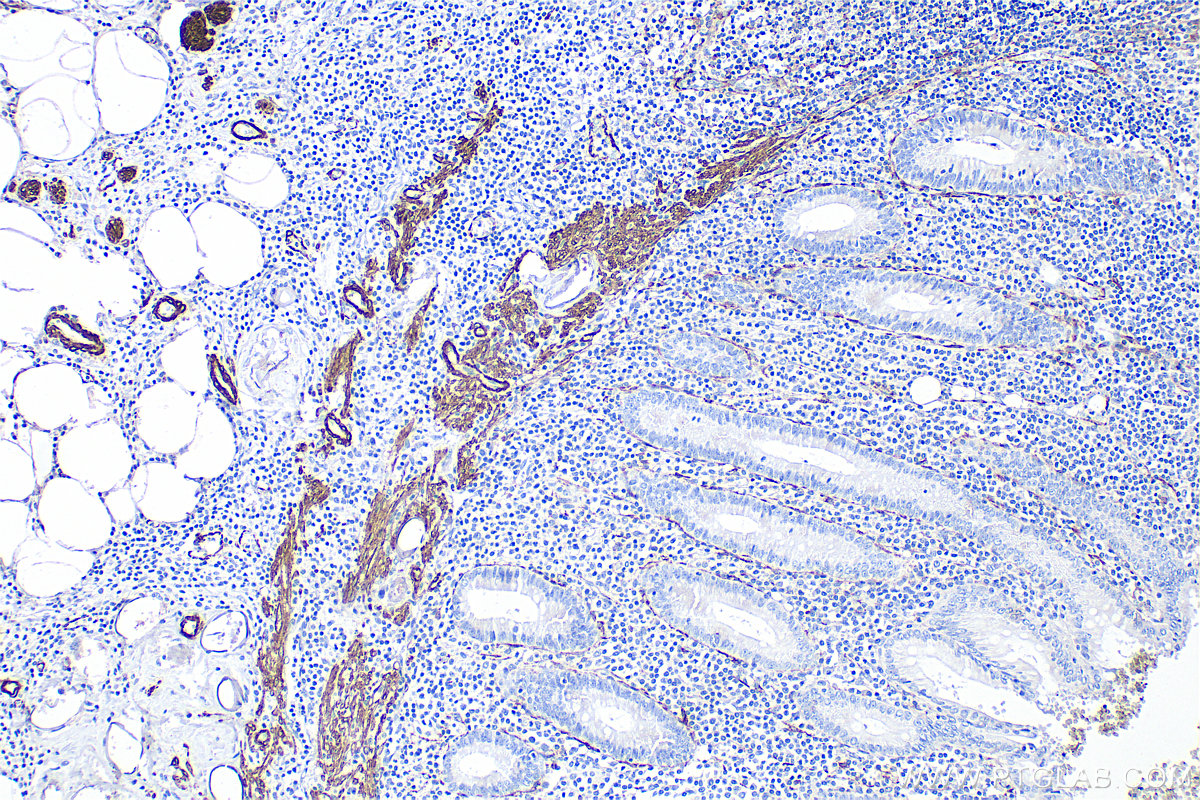 IHC staining of human appendicitis using 14395-1-AP