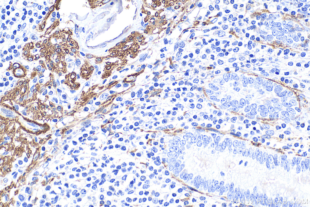 IHC staining of human appendicitis using 14395-1-AP