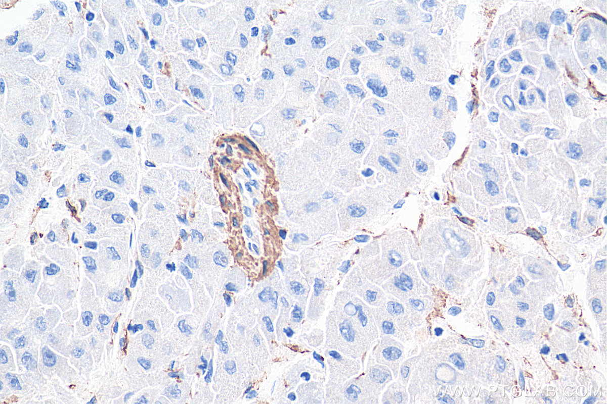 IHC staining of human liver cancer using 55135-1-AP