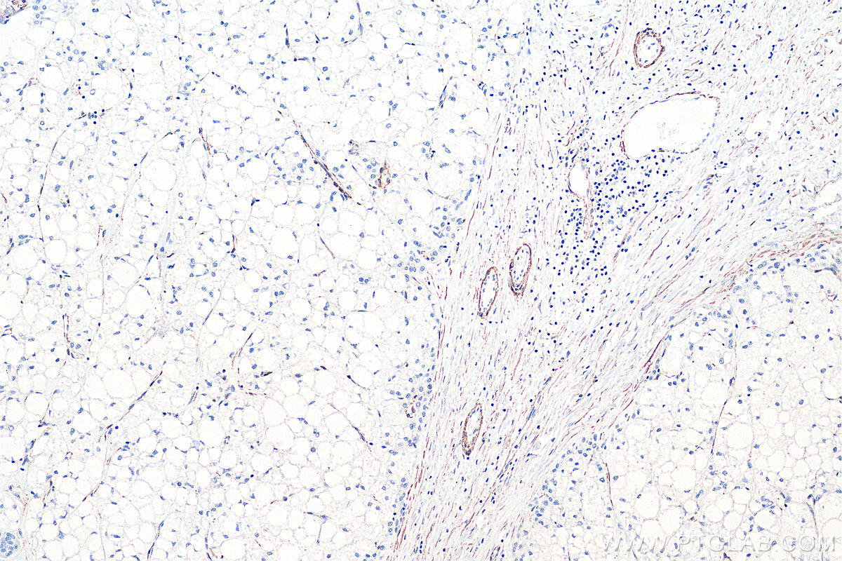 IHC staining of human liver cancer using 55135-1-AP