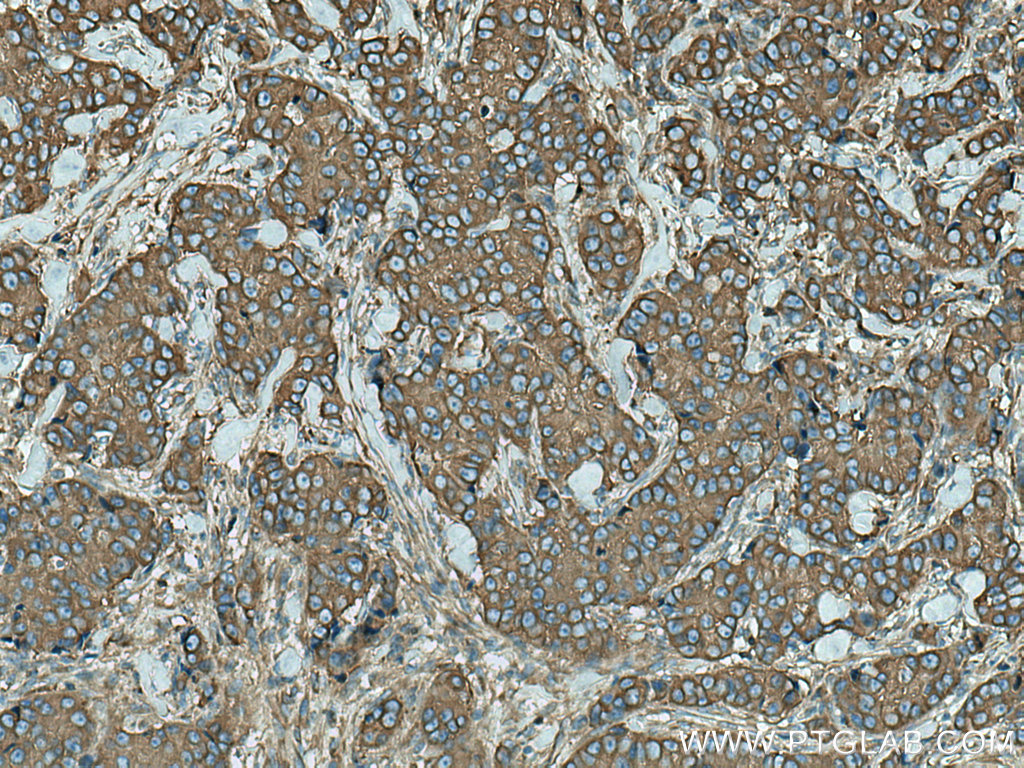 IHC staining of human breast cancer using 66628-1-Ig (same clone as 66628-1-PBS)