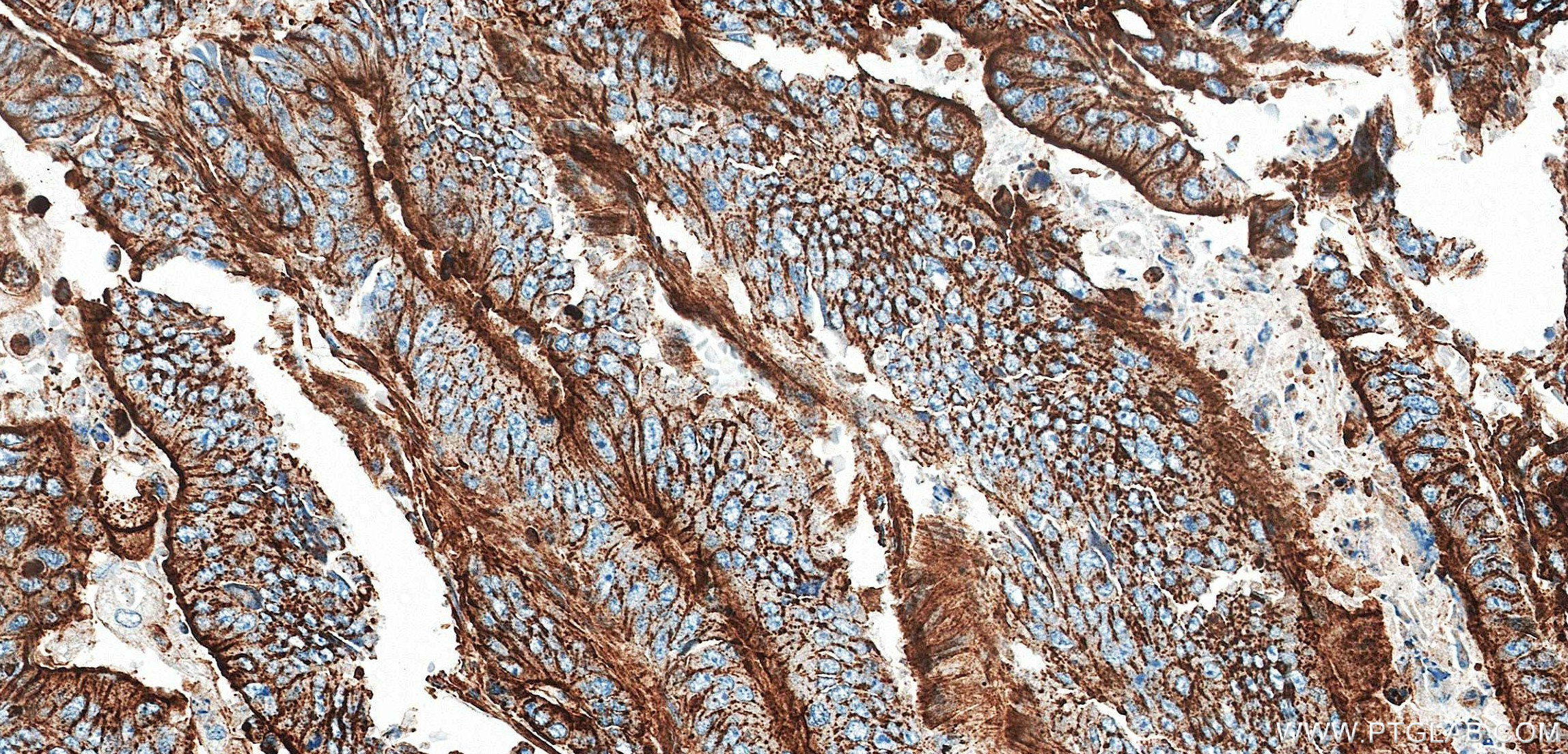 IHC staining of human colon cancer using 87922-1-RR (same clone as 87922-1-PBS) IHC staining of human colon cancer using 87922-1-RR (same clone as 87922-1-PBS)