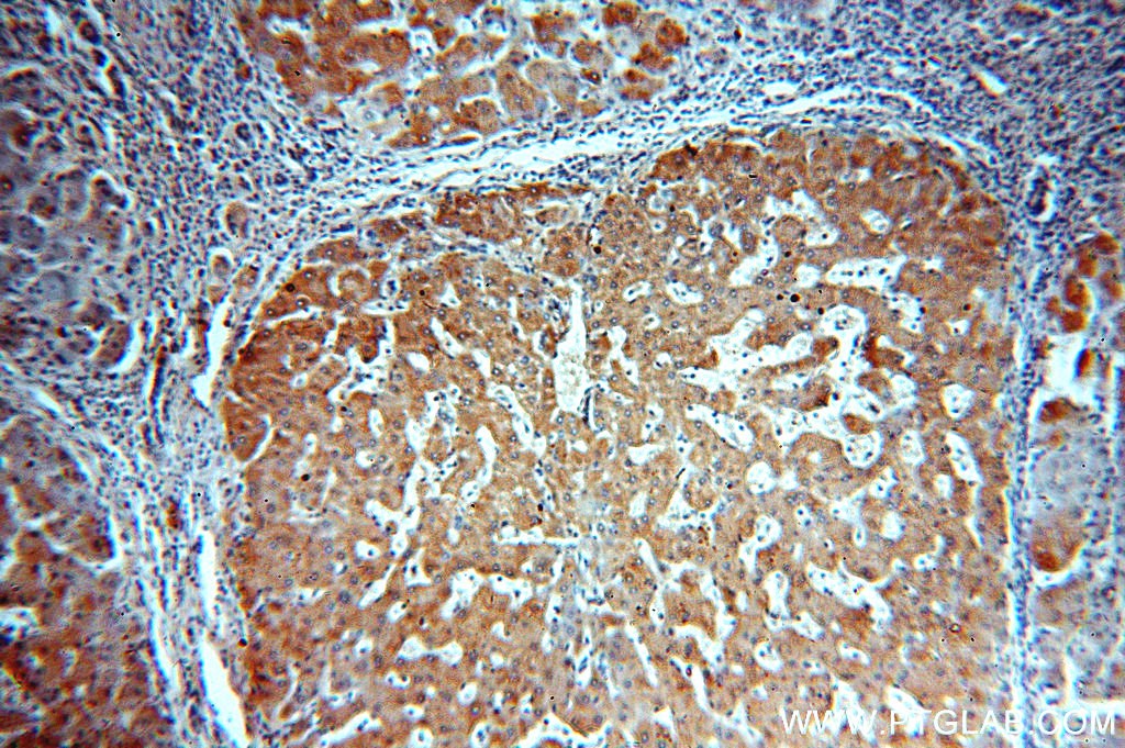 IHC staining of human hepatocirrhosis using 20101-1-AP (same clone as 20101-1-PBS)