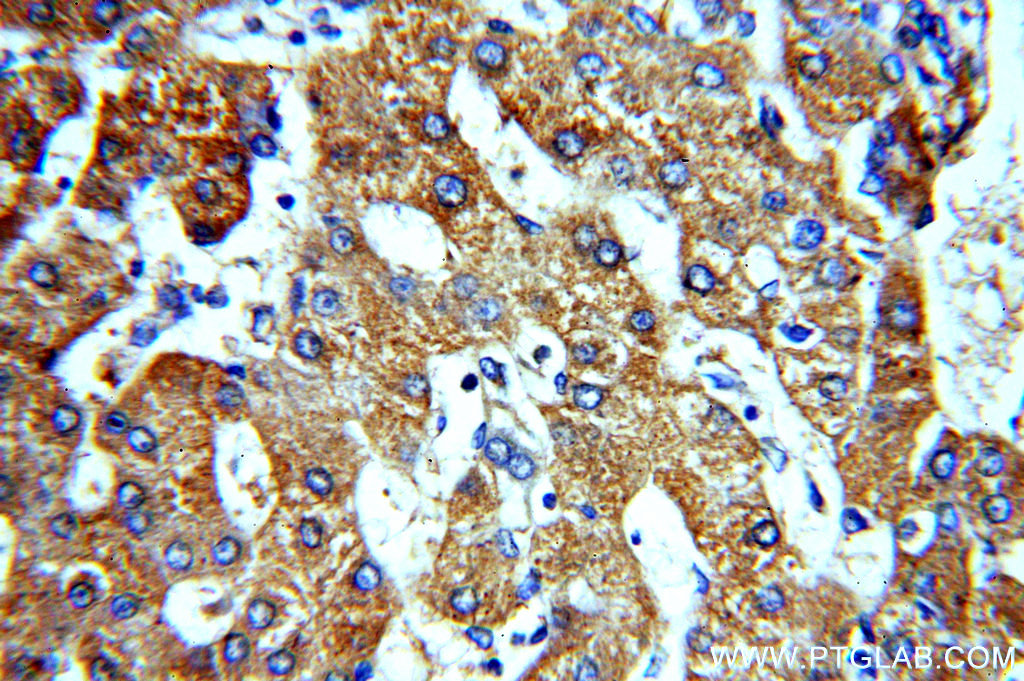 IHC staining of human hepatocirrhosis using 20101-1-AP (same clone as 20101-1-PBS)