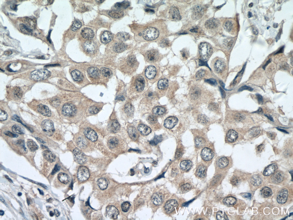 IHC staining of human breast cancer using 11023-1-AP