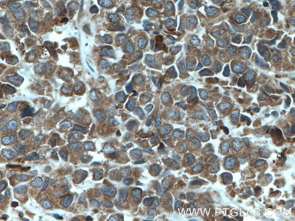 IHC staining of human prostate cancer using 10922-1-AP