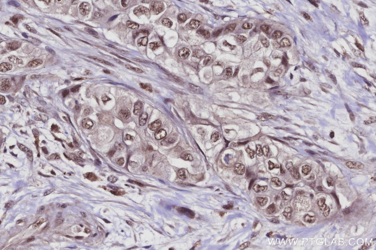 IHC staining of human pancreas cancer using 21505-1-AP IHC staining of human pancreas cancer using 21505-1-AP