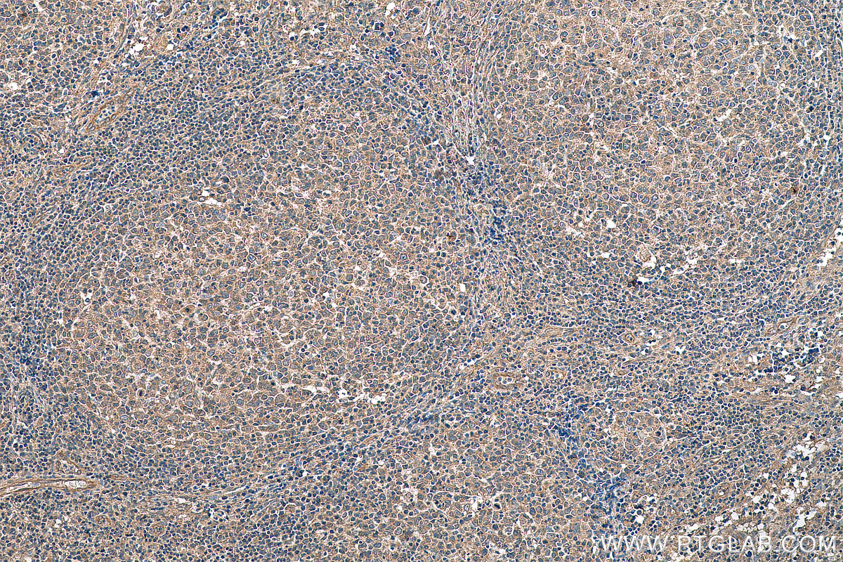 IHC staining of human lymphoma using 66857-1-Ig (same clone as 66857-1-PBS)