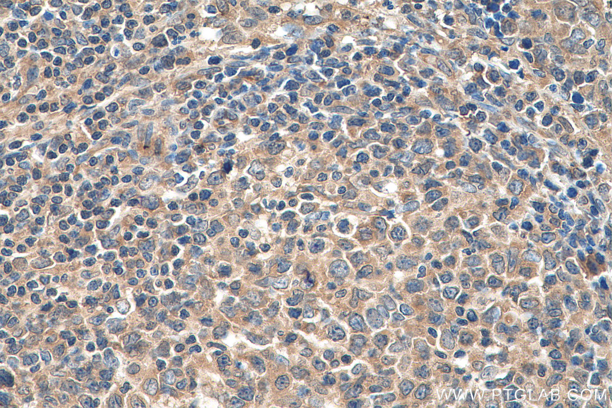 IHC staining of human lymphoma using 66857-1-Ig