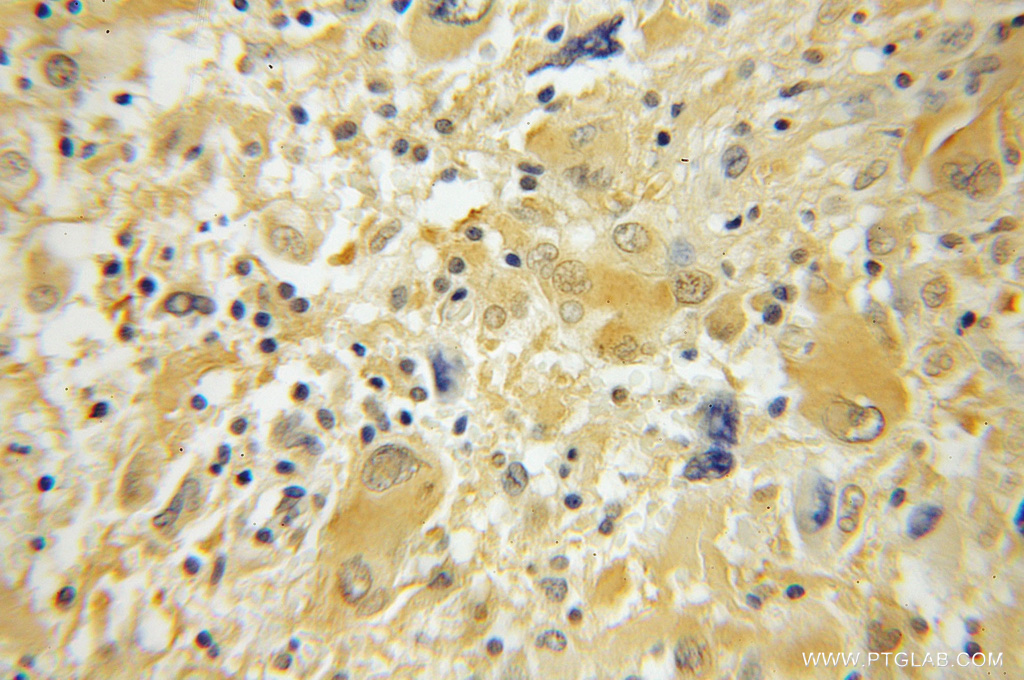 IHC staining of human medulloblastoma using 12302-1-AP