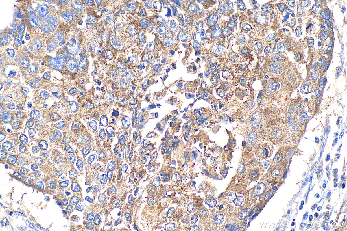 IHC staining of human lung cancer using 25900-1-AP