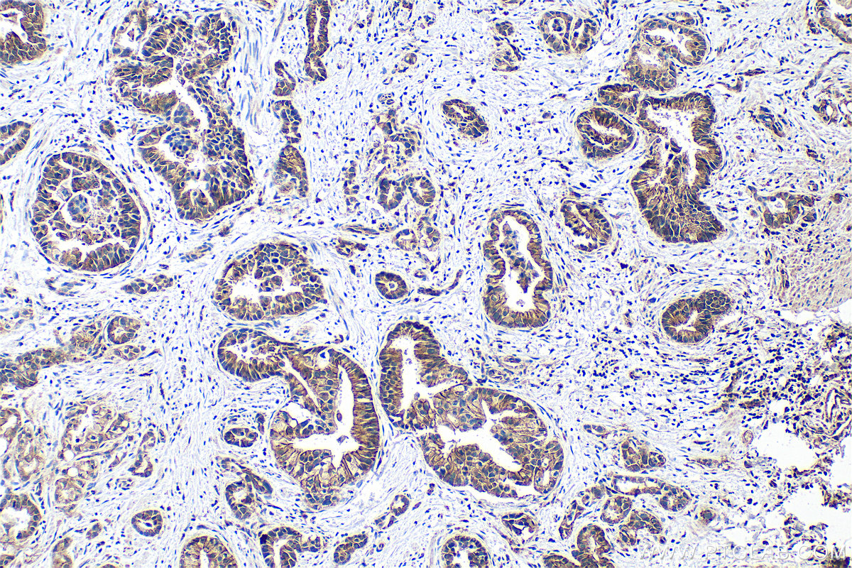 IHC staining of human pancreas cancer using 25900-1-AP