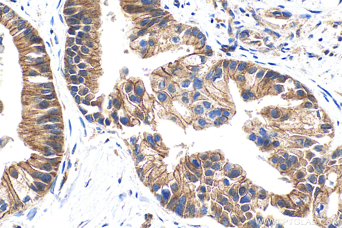 IHC staining of human pancreas cancer using 25900-1-AP