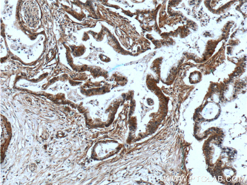 IHC staining of human pancreas cancer using 24620-1-AP