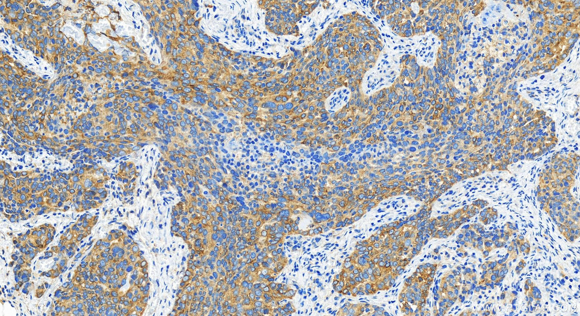 IHC staining of human ovary cancer using 29948-1-AP IHC staining of human ovary cancer using 29948-1-AP