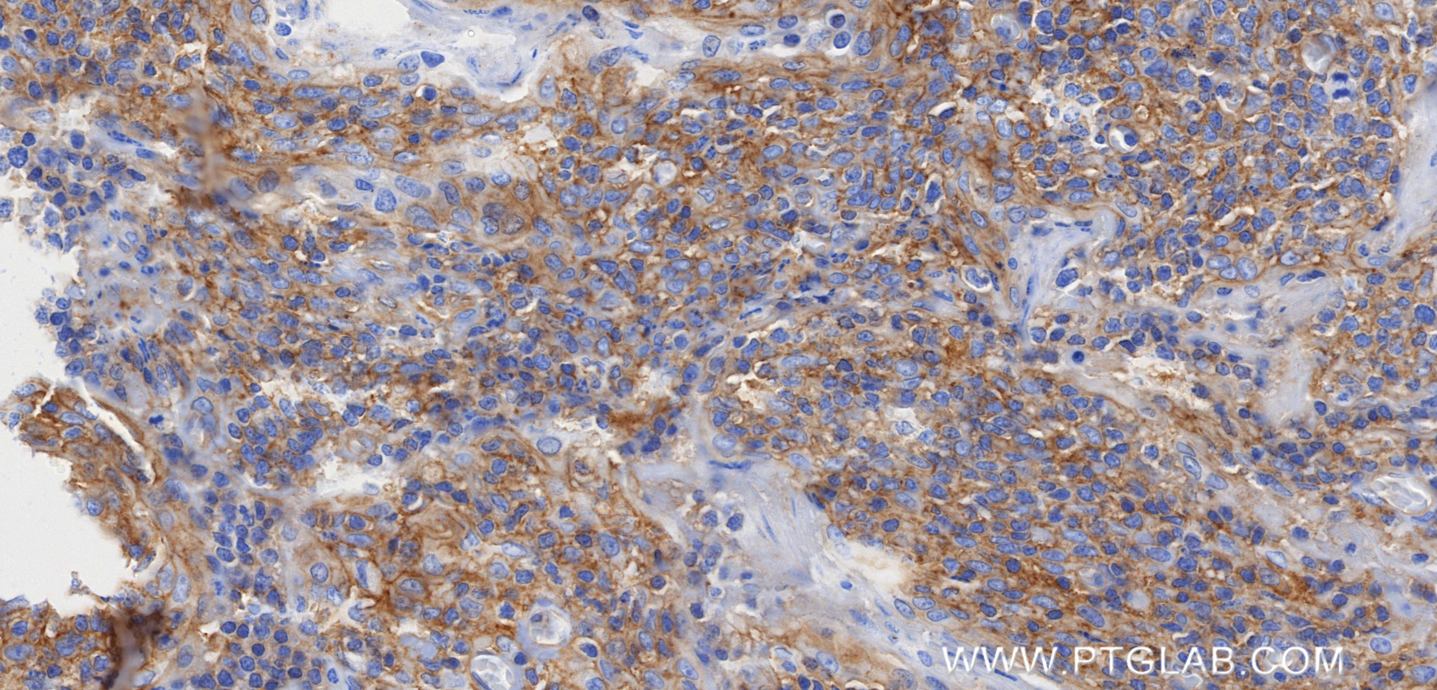 Immunohistochemical analysis of paraffin-embedded human tonsil tissue slide using 84292-4-RR (ADAM17 antibody) at dilution of 1:1000 (under 40x lens). Heat mediated antigen retrieval with Tris-EDTA buffer (pH 9.0). IHC staining of human tonsil using 84292-4-RR