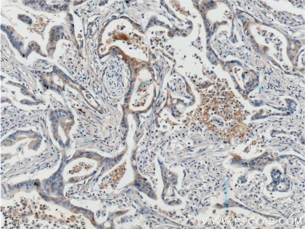 IHC staining of human pancreas cancer using 20259-1-AP