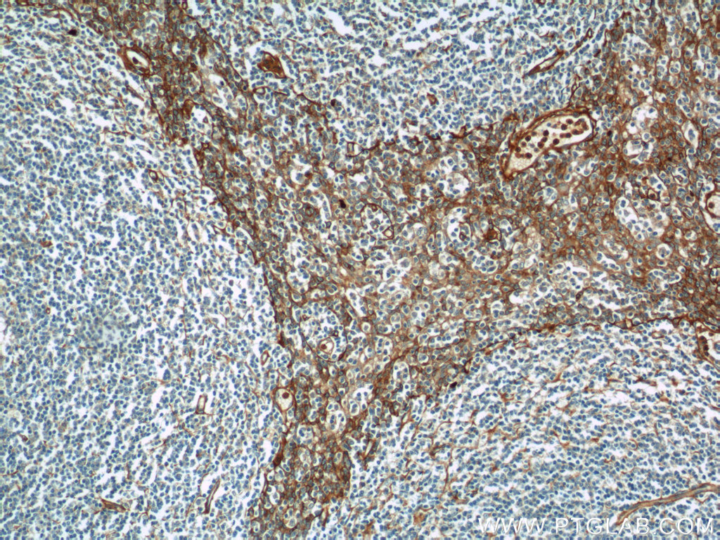 IHC staining of human tonsillitis using 23778-1-AP