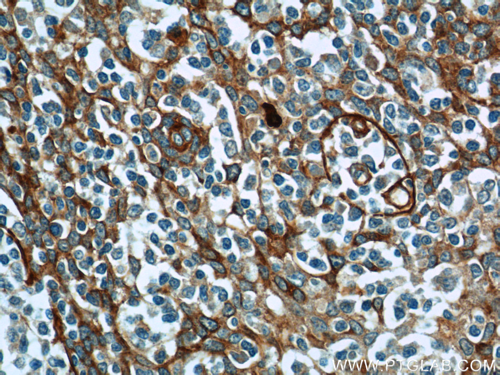 IHC staining of human tonsillitis using 23778-1-AP