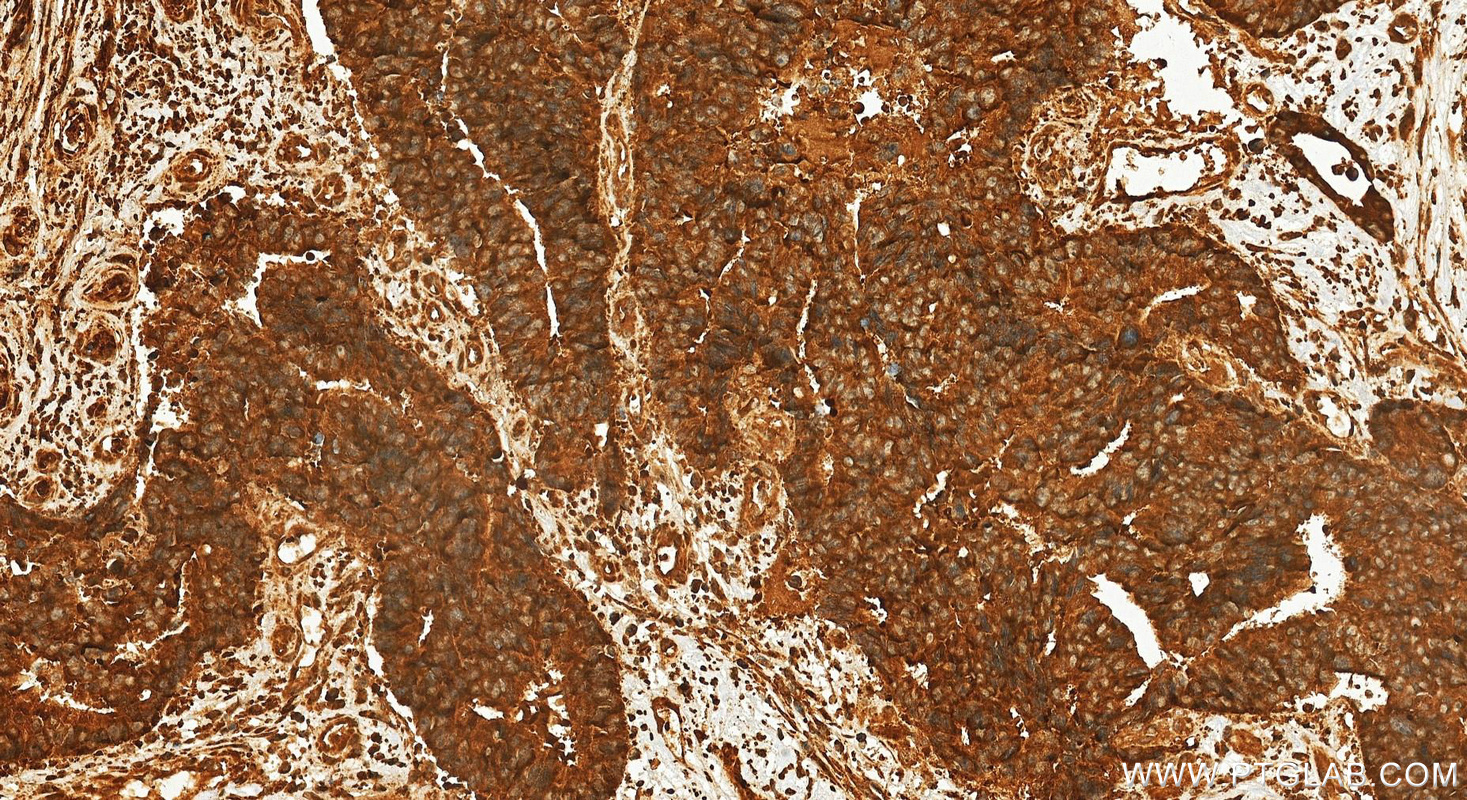 IHC staining of human colon cancer using 17899-1-AP