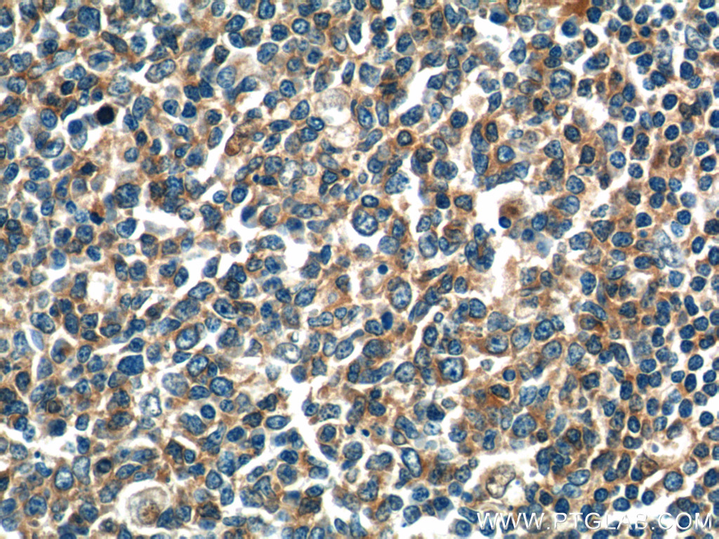 IHC staining of human tonsillitis using 17899-1-AP