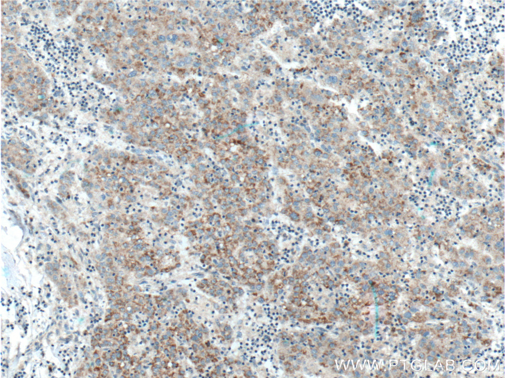 IHC staining of human liver cancer using 12749-1-AP