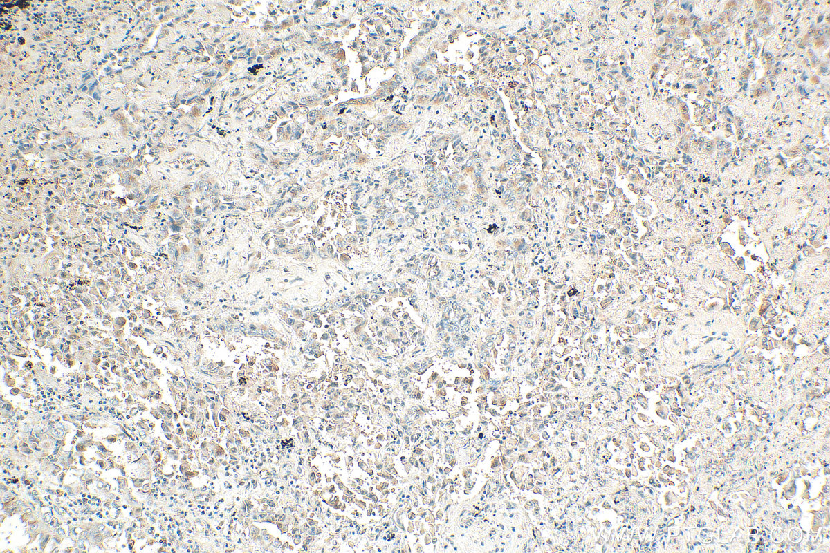 IHC staining of human lung cancer using 31075-1-AP