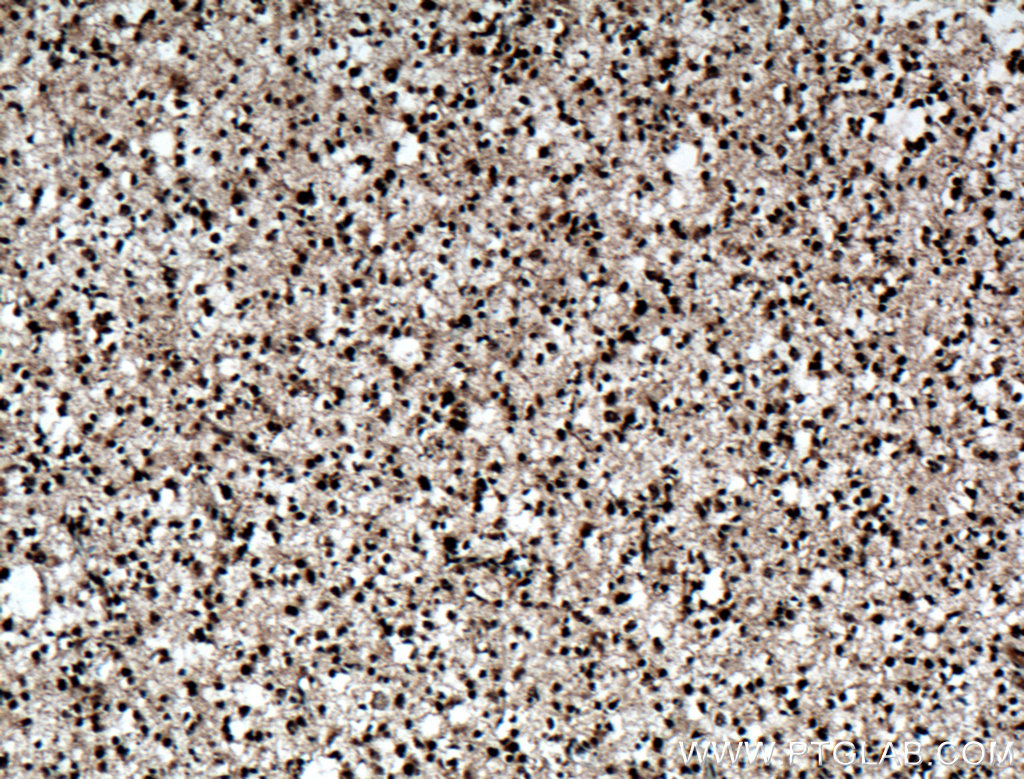 IHC staining of human gliomas using 14330-1-AP