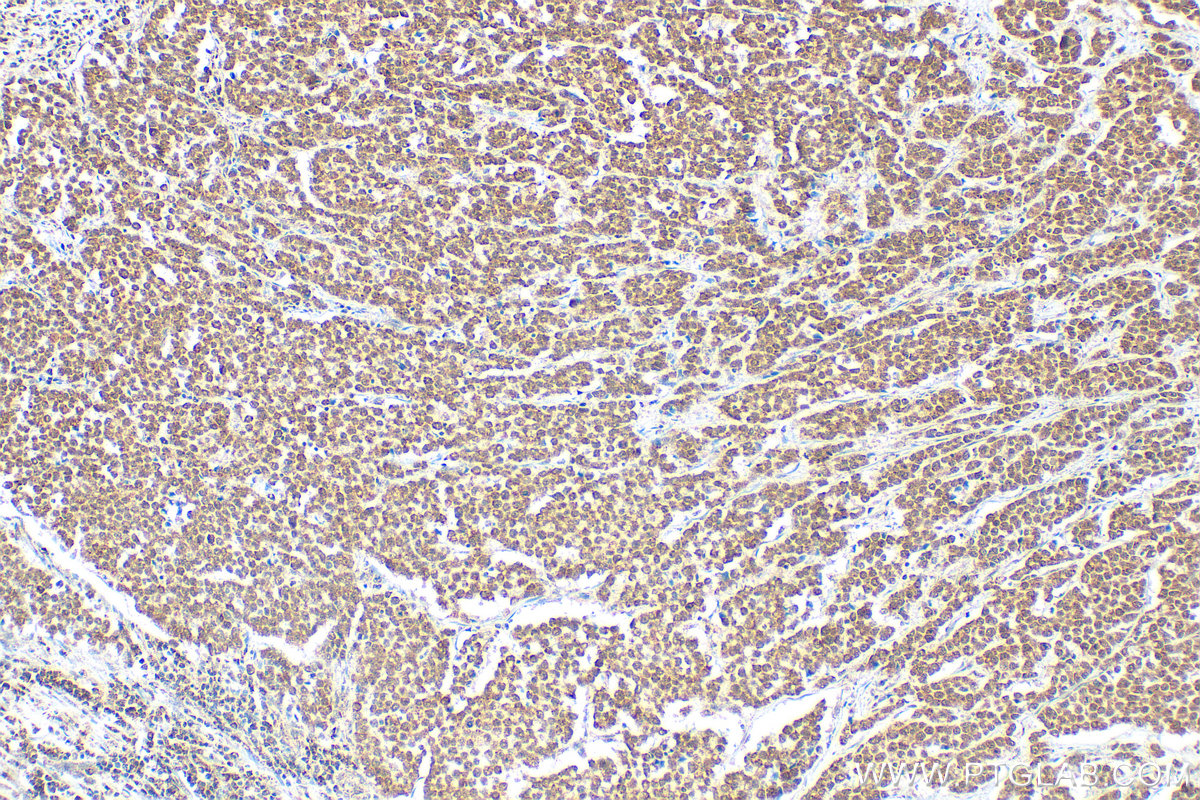 Immunohistochemical analysis of paraffin-embedded human colon cancer tissue slide using 14330-1-AP (ADAR1 antibody) at dilution of 1:200 (under 10x lens). Heat mediated antigen retrieval with Tris-EDTA buffer (pH 9.0). IHC staining of human colon cancer using 14330-1-AP
