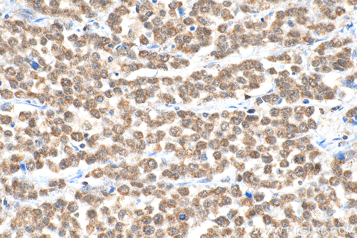 Immunohistochemical analysis of paraffin-embedded human colon cancer tissue slide using 14330-1-AP (ADAR1 antibody) at dilution of 1:200 (under 40x lens). Heat mediated antigen retrieval with Tris-EDTA buffer (pH 9.0). IHC staining of human colon cancer using 14330-1-AP