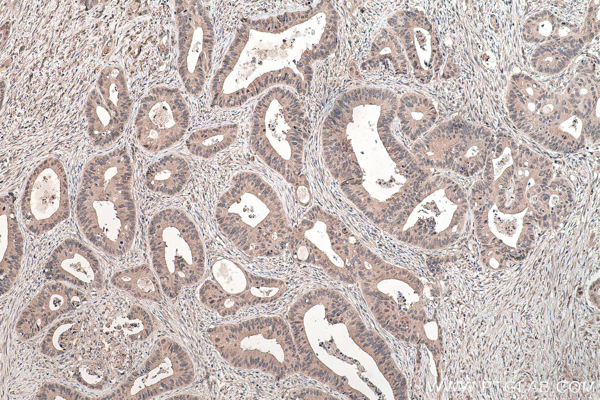 IHC staining of human colon cancer using 13621-1-AP