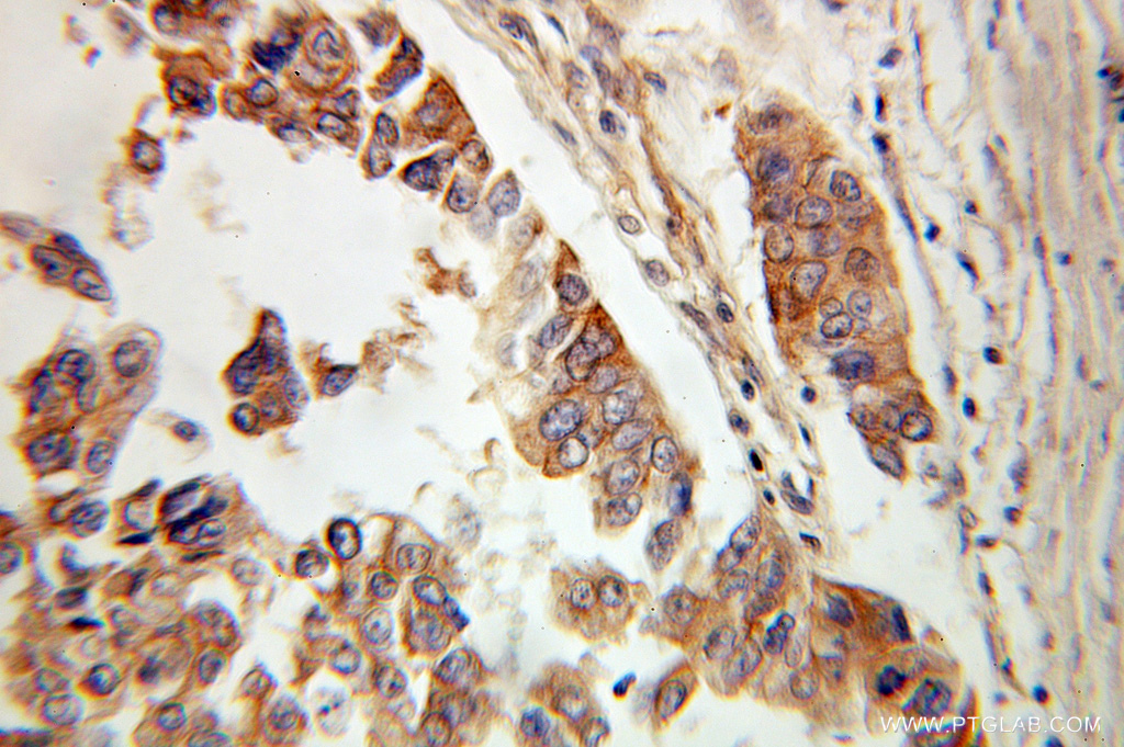 IHC staining of human ovary tumor using 10791-1-AP