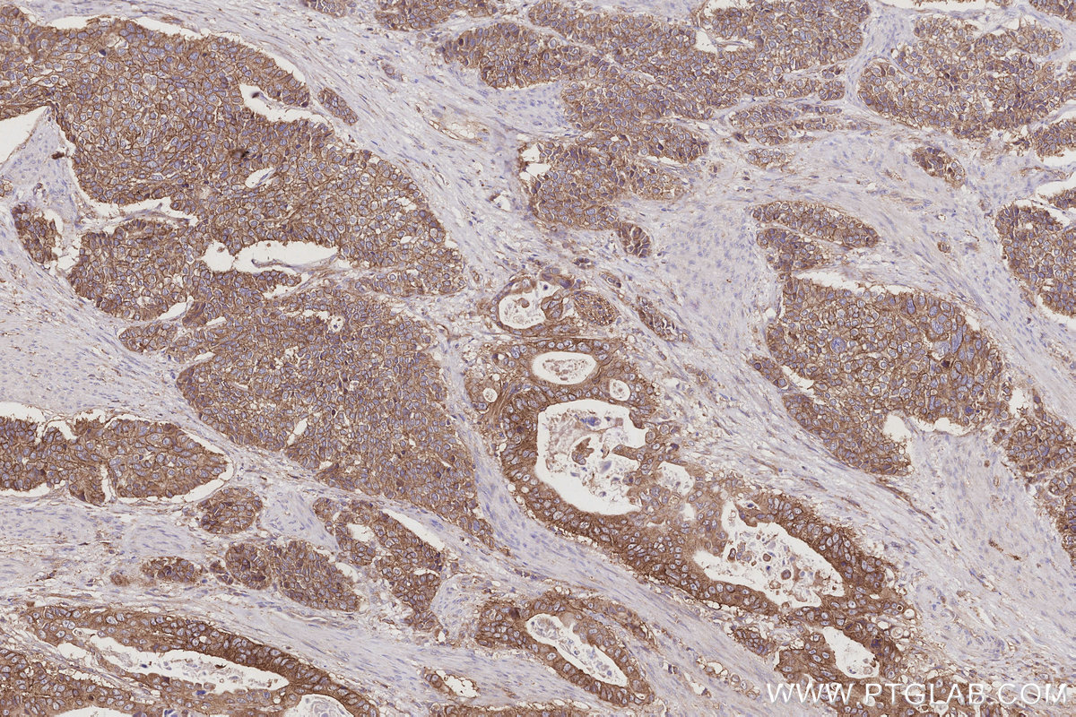 IHC staining of human stomach cancer using 17585-1-AP IHC staining of human stomach cancer using 17585-1-AP