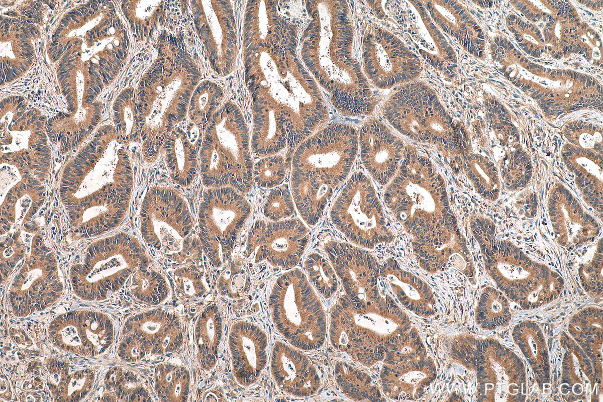 IHC staining of human colon cancer using 19359-1-AP