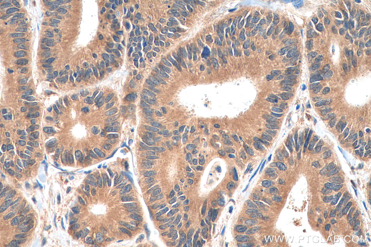 IHC staining of human colon cancer using 19359-1-AP