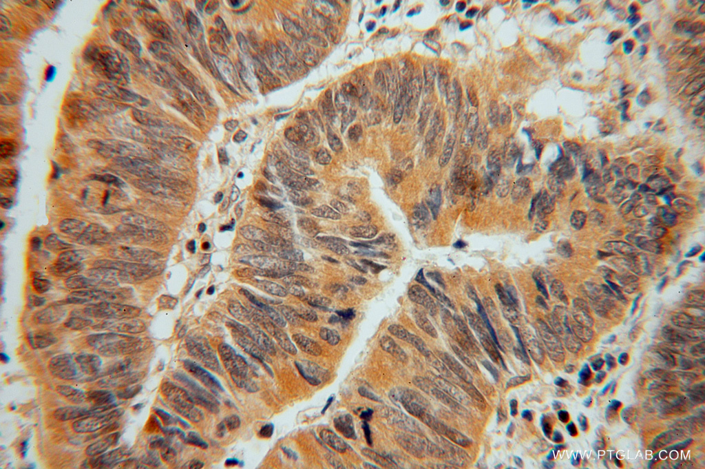 IHC staining of human colon cancer using 15133-1-AP