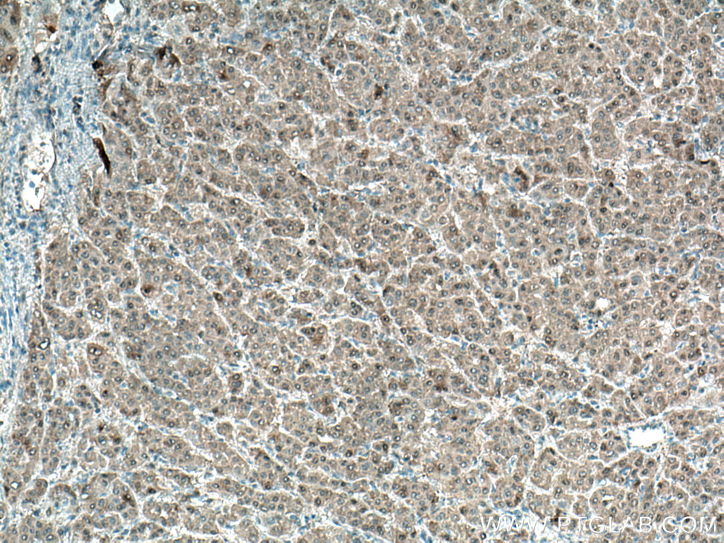 IHC staining of human liver cancer using 66929-1-Ig