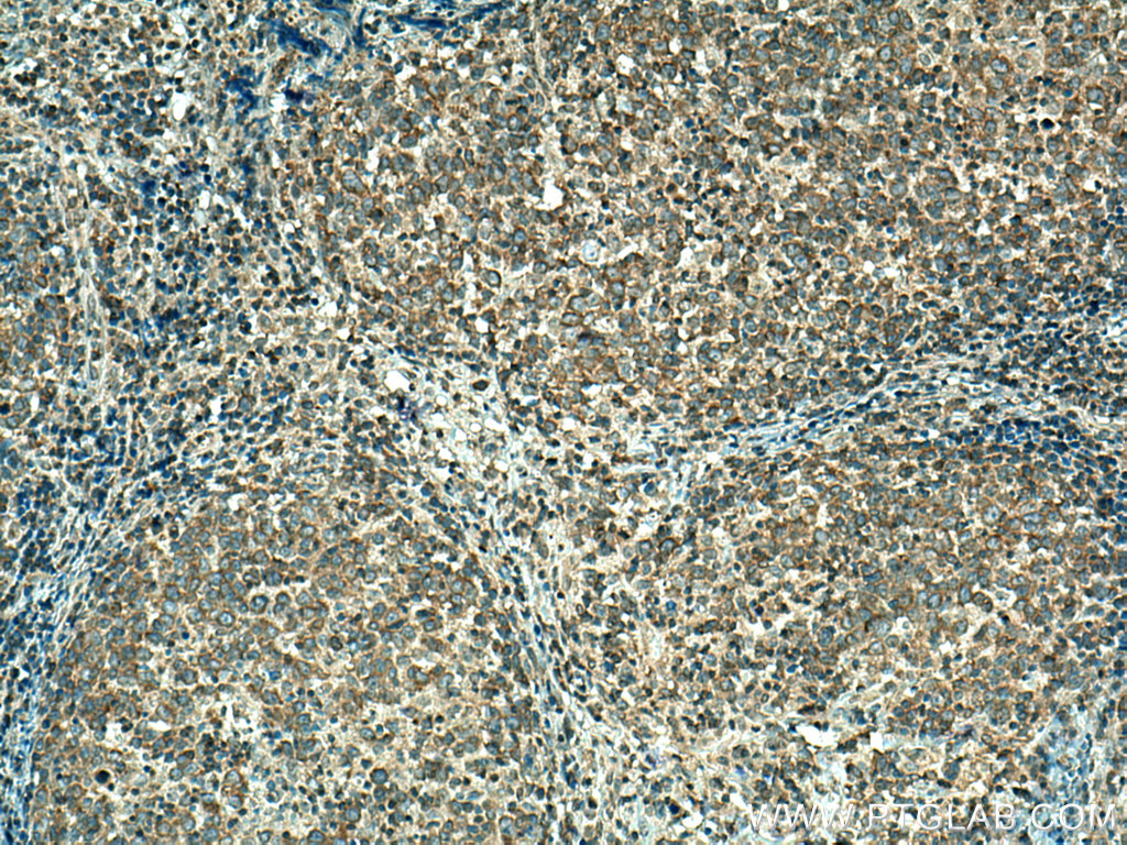 IHC staining of human lymphoma using 13990-1-AP