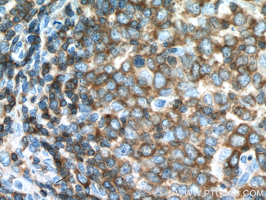 IHC staining of human lymphoma using 67067-1-Ig