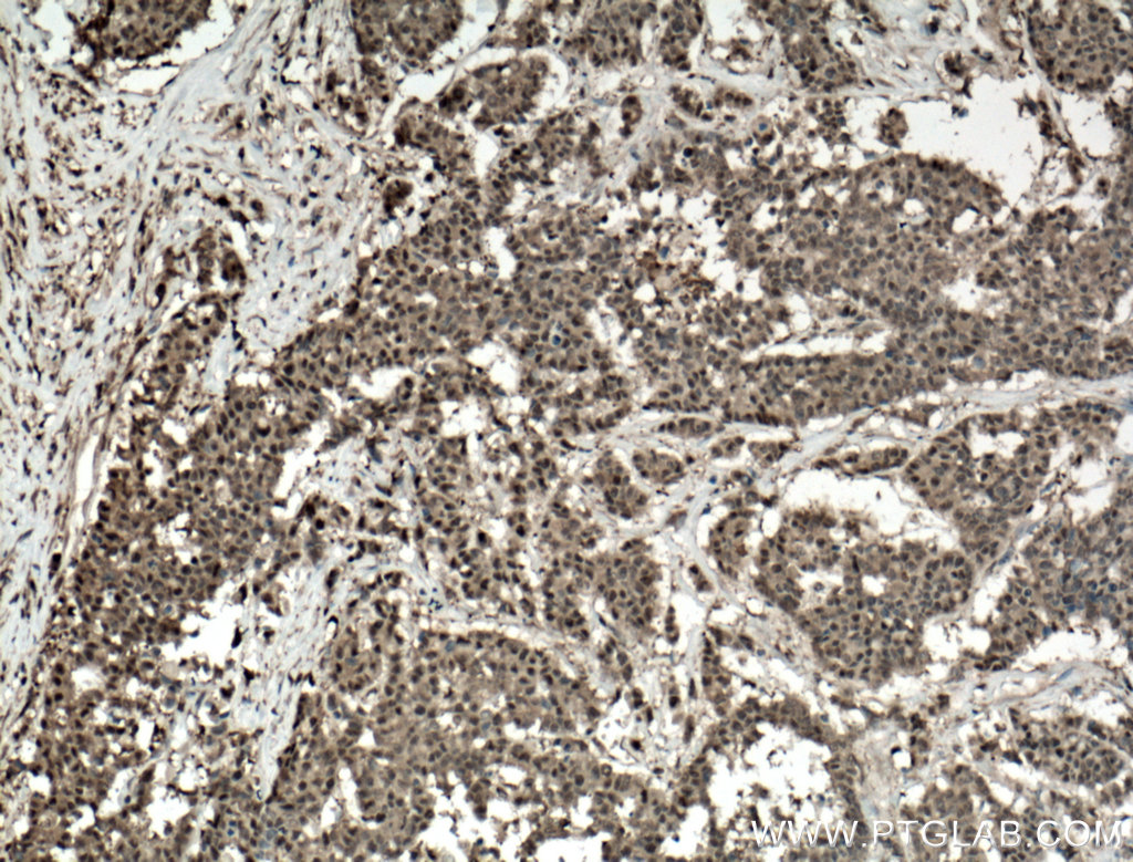 IHC staining of human colon cancer using 11468-1-AP
