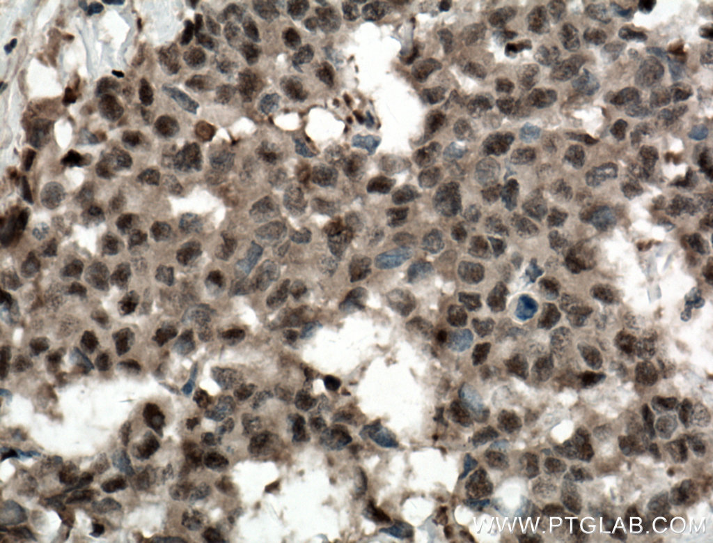 IHC staining of human colon cancer using 11468-1-AP